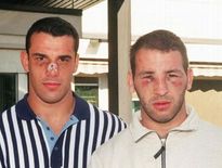 Les visages tuméfiés de Cristophe Lamaison et Philippe Carbonneau après la « bataille du Toulzac »